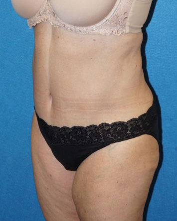 Tummy Tuck