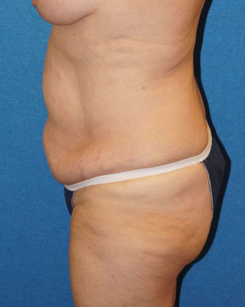 Tummy Tuck