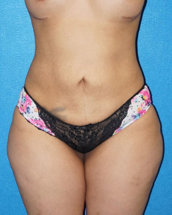 Tummy Tuck