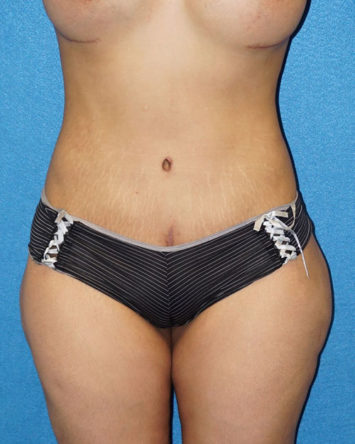 Tummy Tuck