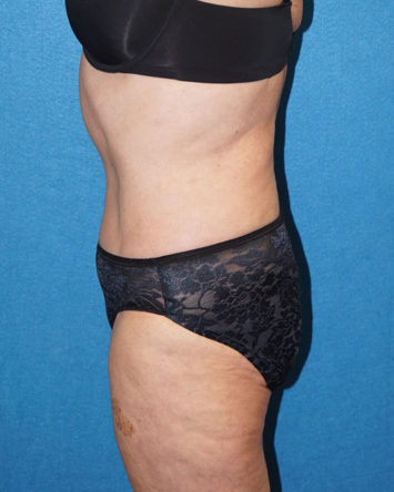 Tummy Tuck