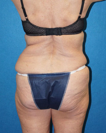 Tummy Tuck