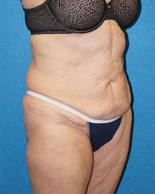 Tummy Tuck