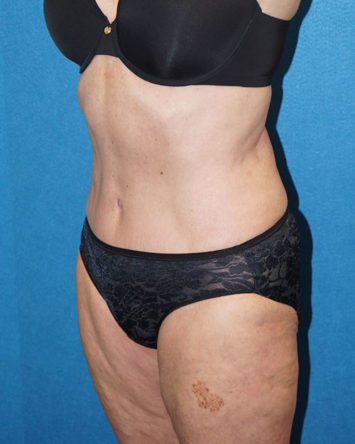 Tummy Tuck