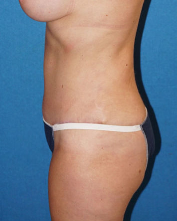 Tummy Tuck