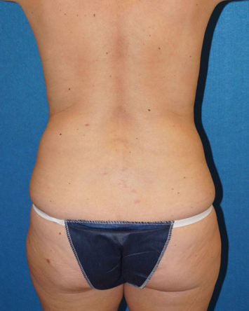 Tummy Tuck