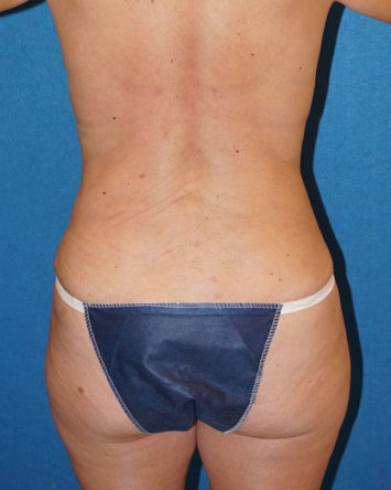 Tummy Tuck