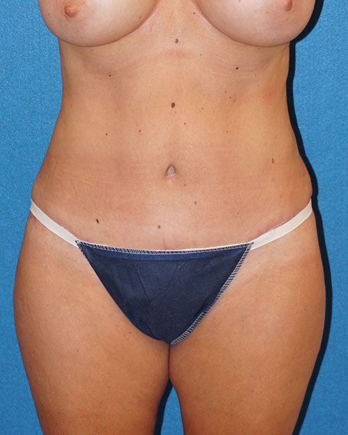 Tummy Tuck