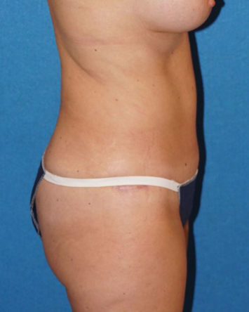 Tummy Tuck