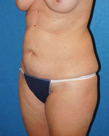 Tummy Tuck