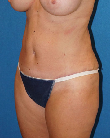 Tummy Tuck