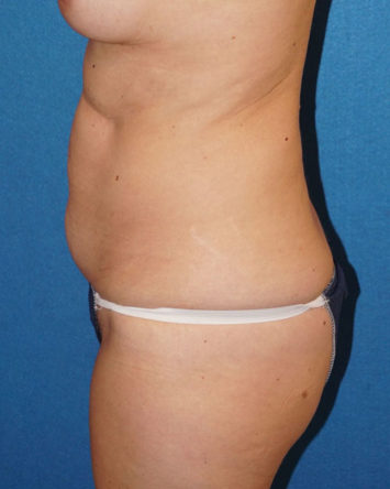 Tummy Tuck