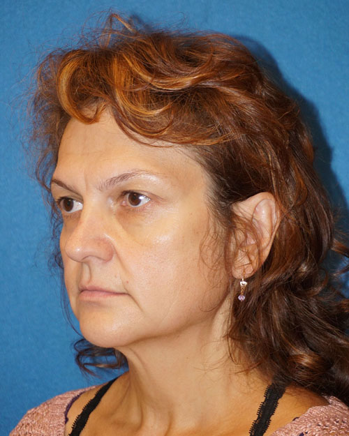 Sacramento Levantamiento de Cara Before and After Photos Roseville