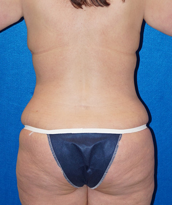 Tummy Tuck