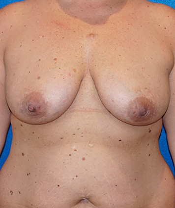 Mastopexia y aumento de senos (levantamiento de senos con aumento)