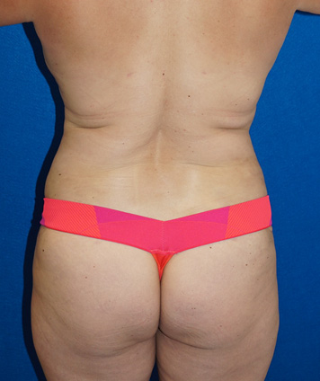 Tummy Tuck