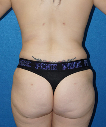 Tummy Tuck