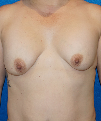 Mastopexia y aumento de senos (levantamiento de senos con aumento)