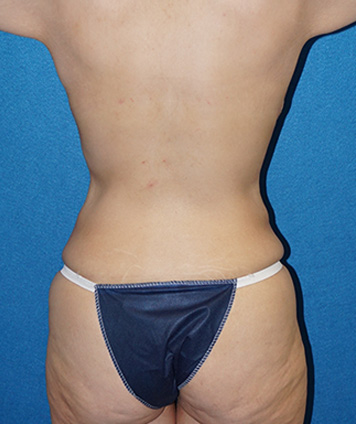 Tummy Tuck