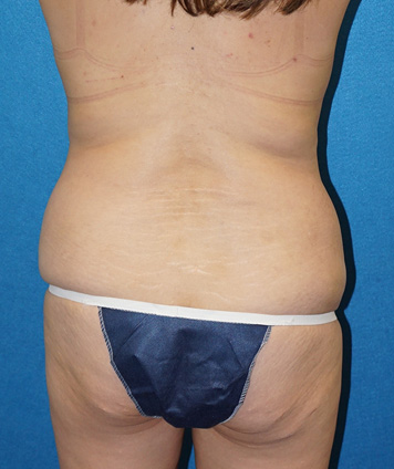 Tummy Tuck